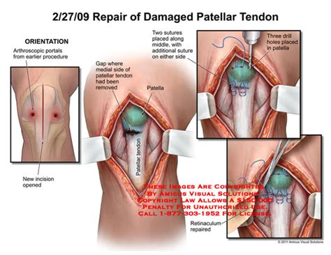 AMICUS Illustration of amicus,surgery,knee,repaired,damaged,patellar,tendon,arthroscopic,portals ...