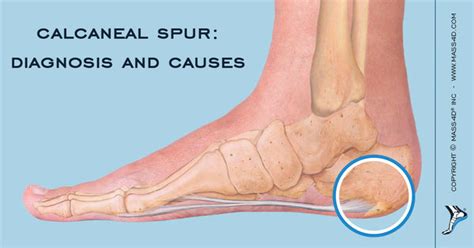 Diagnosis, Causes and Treatments of Heel Spurs - MASS4D® Foot Orthotics