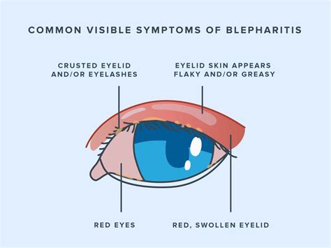 Blepharitis: Symptoms, Causes, and Treatment | Warby Parker