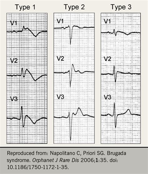 Brugada Syndrome Ecg Patterns