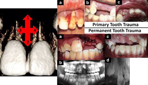 Various types of luxation injuries: Left side showing directions of ...