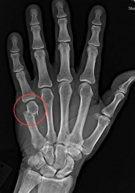 X ray of broken pinky finger: Broken Finger Symptoms, X-Ray, Tips ...