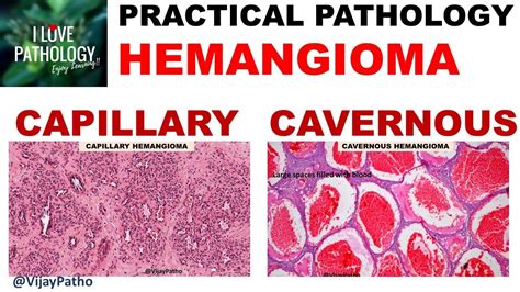 HEMANGIOMA: capillary & Cavernous. Clinical features & Morphology - YouTube