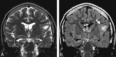 Hippocampus Brain Mri