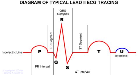 ECG TRACING Flashcards | Quizlet