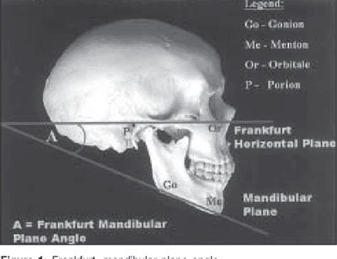 [PDF] Significance of the Frankfort mandibular plane angle in ...