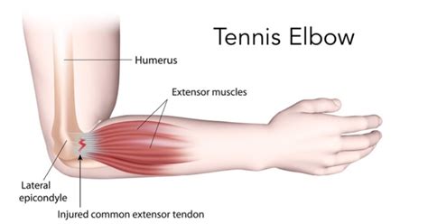 Tennis Elbow – what causes it, symptoms and treatment – Body Equilibrium Sports Massage and ...