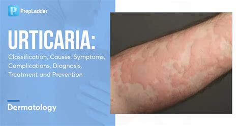 Urticaria: Classification, Causes, Symptoms, Complications