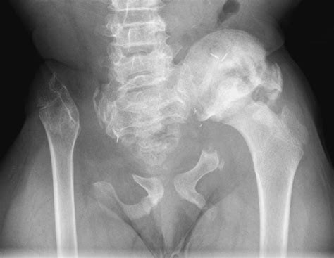 Figure 1 from Bilateral internal hemipelvectomy for osteosarcoma in a pediatric patient ...