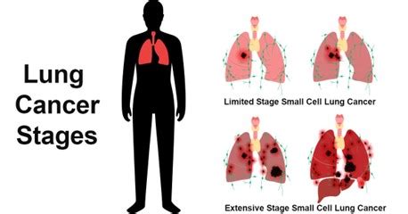 Limited vs. Extensive Stage Small Cell Lung Cancer | BIS Research News