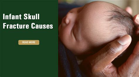 Infant Skull Fracture Causes | Medical Malpractice | Raynes Lawn