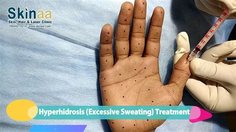 Hyperhidrosis -Excessive sweating treatment in India | Botox Injection ...