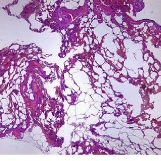 (PDF) Spinal extradural angiolipoma: Report of two cases and review of the literature