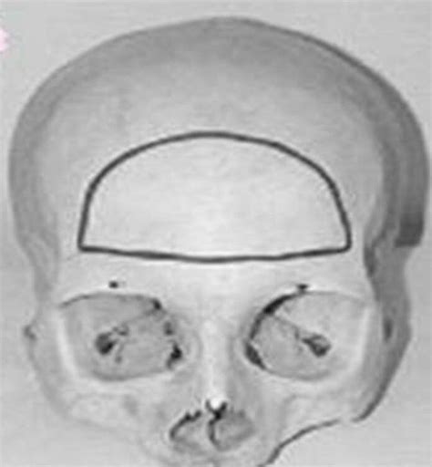 Bifrontal craniotomy Fig. 2: frontolateral craniotomy | Download Scientific Diagram