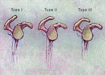 Subacromial Impingement Syndrome: Q: What Causes Subacromial ...