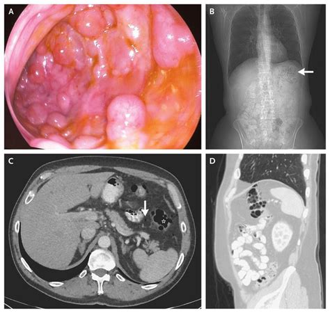 Pneumatosis Intestinalis - MEDizzy