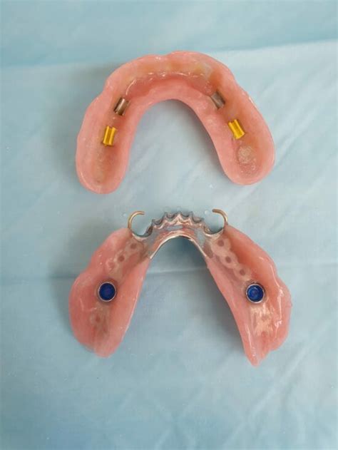 Implant Dentures (Partial)