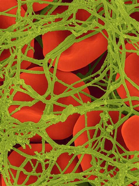 Blood Clot Photograph by Dennis Kunkel Microscopy/science Photo Library