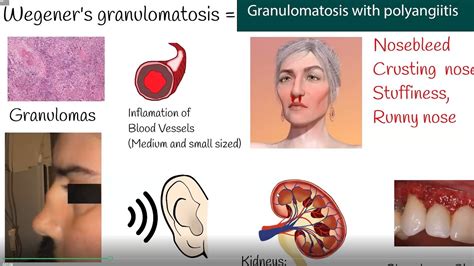 Wegener's granulomatosis - Granulomatosis with polyangiitis - Symptoms ...