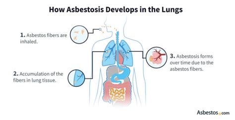 Asbestosis: Discover Causes, Symptoms, Treatment and More