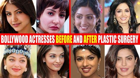 Actresses Before And After Surgery