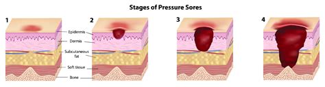 Your Wheelchair Guide: Reduce Pressure Sores on the Buttocks from Sitting