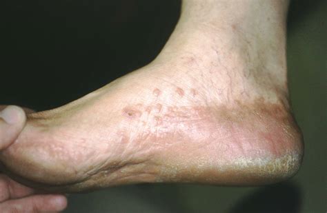 psoriasis sole foot - The Skin and Wellness Center