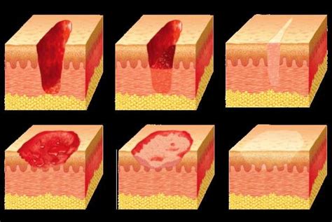 Illustration of common open wound and healing process (Image courtesy... | Download Scientific ...