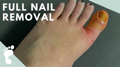 Complete Toenail Avulsion - YouTube