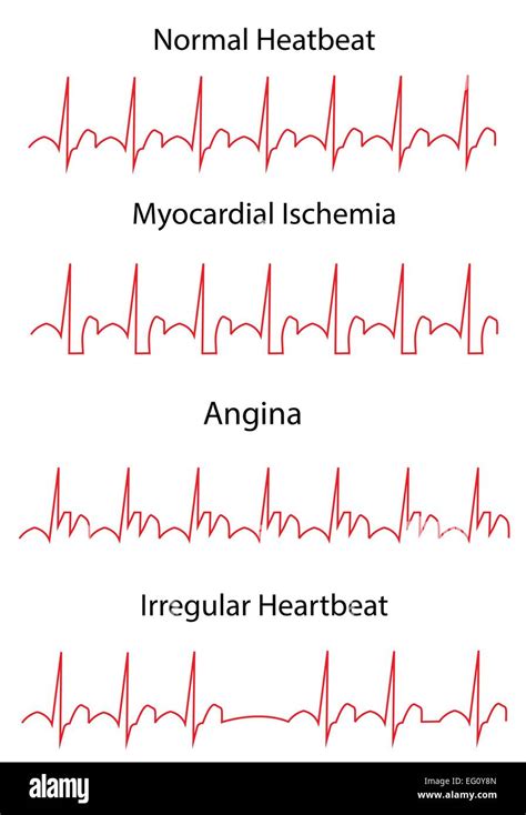 ECG EKG Heart Disease Stock Vector Image & Art - Alamy