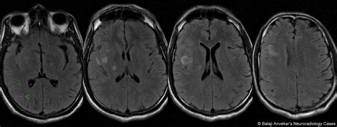 Infarction: Punctate Infarct