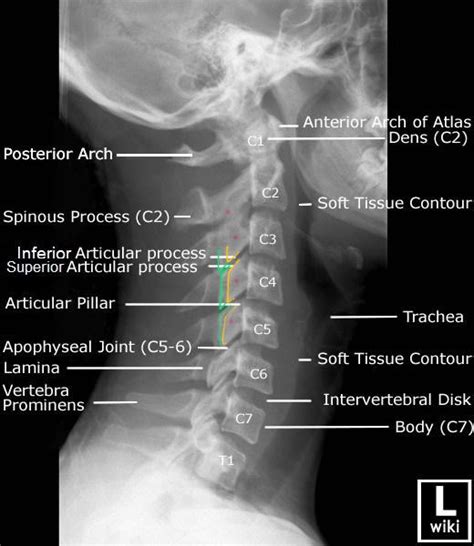 Cervical Spine Fluoroscopic Anatomy for the Pain Management Interventionalist - The Procedure Guide