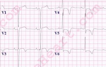 Left Ventricular Hypertrophy (LVH) ECG Review | Learn the Heart