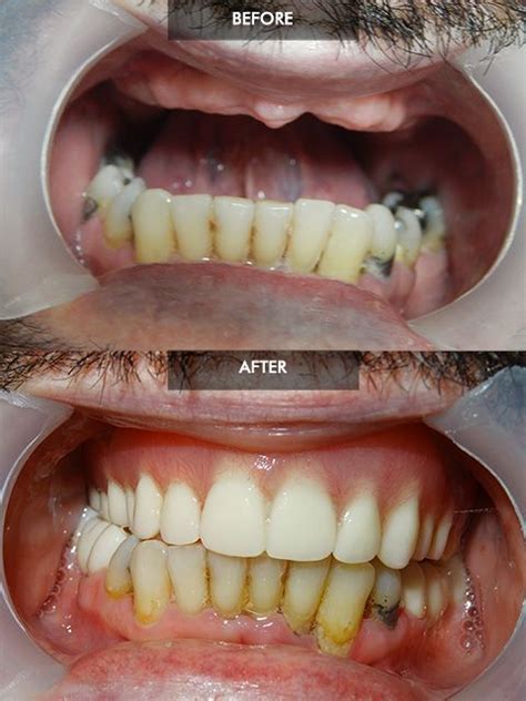 Before and after Fixed Hybrid Denture | Dental treatment, Dental ...