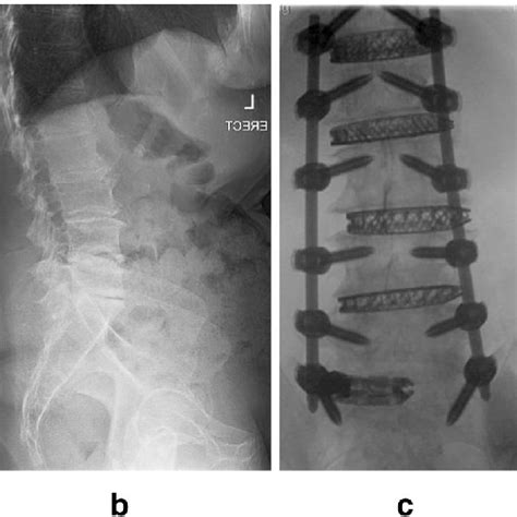 Illustrations comparing the LLIF (a) and OLIF (b) approaches. Note how... | Download Scientific ...