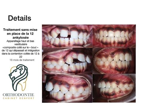 Orthodontie Denfert - Orthodontie par Gouttières