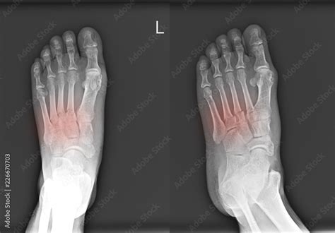 X-ray foot AP OBLIQUE Fracture proximal metaphysis of the 2nd,3rd,and 4th metatarsal bones ...