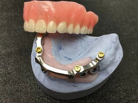 Metal and Plastic Surface Cleaning Implant Overdenture Model, For ...