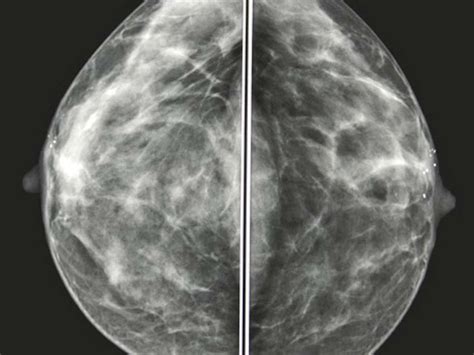 Mammogram images: Normal, abnormal, and breast cancer