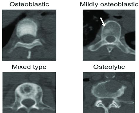 Typical examples of four types of bone metastasis. The arrow indicates... | Download Scientific ...