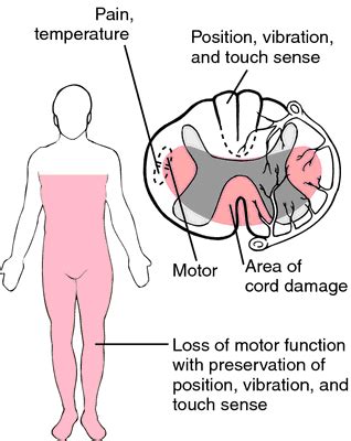 Infarction: Anterior Infarct Symptoms