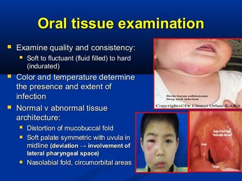 Odontogenic Infection