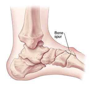 Foot Surgery: Bone Spurs | Saint Luke's Health System