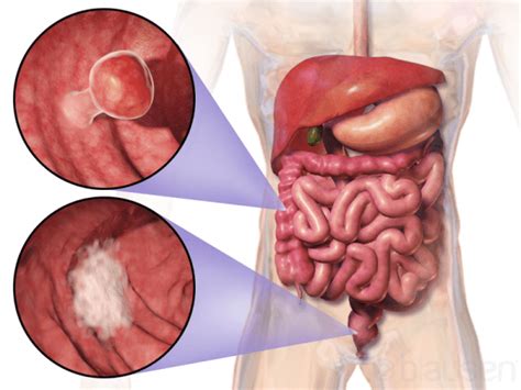 At home test for colon cancer screening receives unanimous support from FDA advisors (10-0)