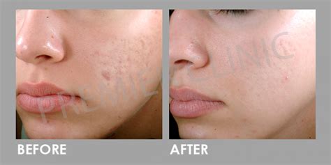 Microdermabrasion for Skin Pigmentation Treatment | Premier Clinic