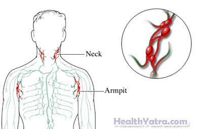 Chronic Lymphadenitis Definition, Causes, Symptoms, Complications and ...