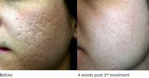 acne-scar-removal-treatment-melbourne-before-and-after-3-treatments ...