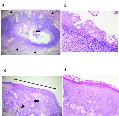 Histopathology of excised caruncular tissues. a: Left eye. Central duct ...