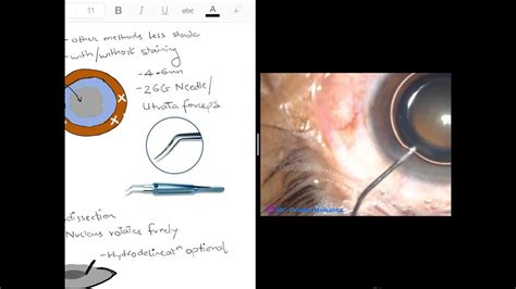Phacoemulsification - Basic Concepts - YouTube