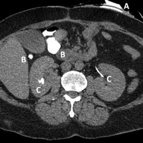 Abdominal native CT-scan made 1 h after enteroclysis showing contrast... | Download Scientific ...